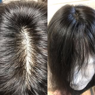 Women’s & Mens custom made Remy human hair units. This belongs to a lady client with 40% hair loss .