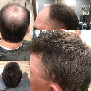 Before and after non surgical hair replacement #hairlosssolutionsandiego #nonsurgicalhairlosssolutio