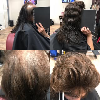 #womenshairloss #hairlosssutions #thinninghairsolutions #menwomenhairloss #chulavistahairreplacement