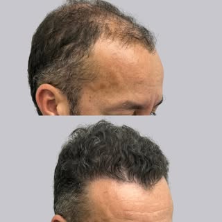 Nuevo comienzo de semana, nuevo caso de cirugía capilar de uno de nuestros pacientes ✨ ¿Qué les pare