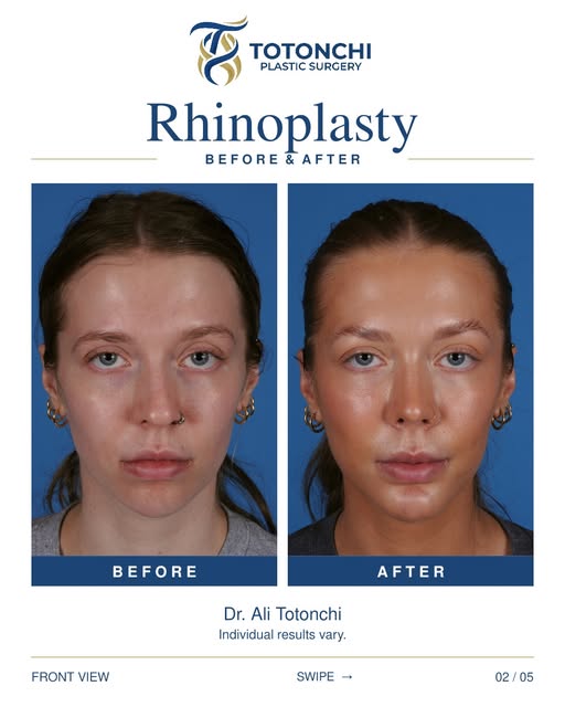 A closer look at rhinoplasty results. ✨

This before-and-after highlights one patient’s rhinoplasty 