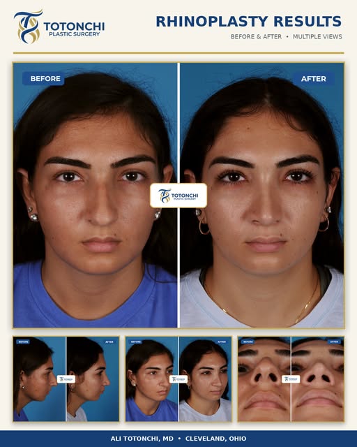 Natural refinement. Beautiful balance. Results designed for the individual. ✨

This rhinoplasty tran