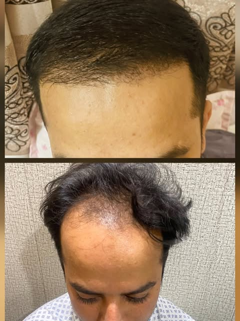 R&H Aesthetic by Dr Abdul Malik Plastic and Cosmetic Surgeon 

Note the marked improvement in hair t