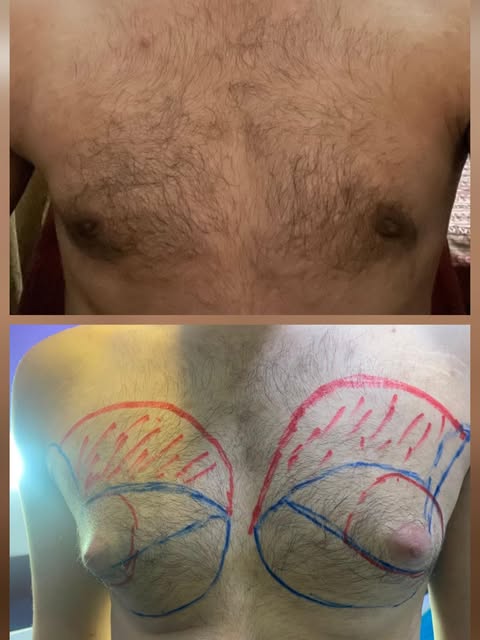 R&H Aesthetics by Dr. Abdul Malik
Plastic Surgeon

Gynecomastia Surgery | Before & After

A confiden