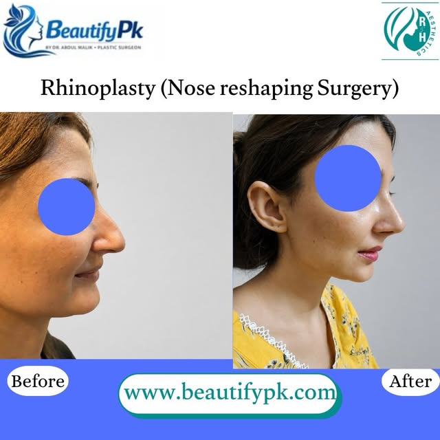 Rhinoplasty by Dr Abdul Malik Mujahid - plastic and cosmetic surgeon 
Before & After  surgery result