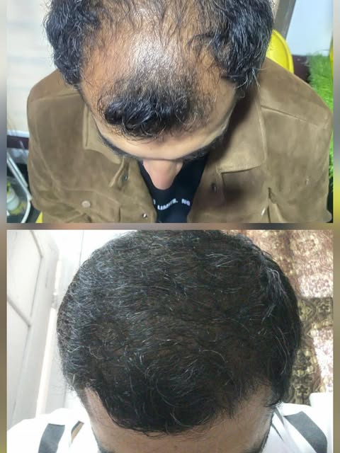 R&H Aesthetic by Dr Abdul Malik Plastic and Cosmetic Surgeon 

Note the marked improvement in hair t