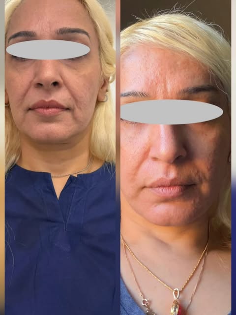 Deep plane face lift , neck lift surgery , lower eyelids / eyebags surgery ( blephroplasty ) , templ