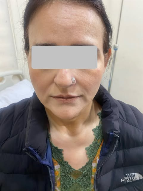 Deep plane face lift and neck lift surgery  with platysma plication/ palatysmaplasty In post bariatr