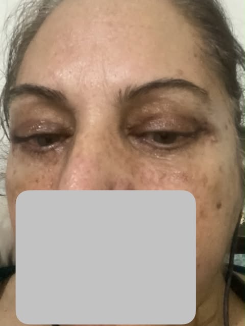 Upper and lower Blepharoplasty with fat grafting - by Dr Abdul Malik Mujahid  plastic and cosmetic s