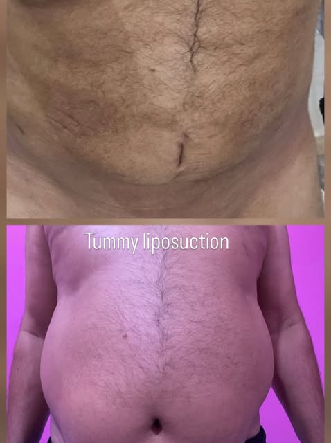 Before and after surgery results - by Dr Abdul Malik Plastic and cosmetic surgeon in Lahore 

2 mont