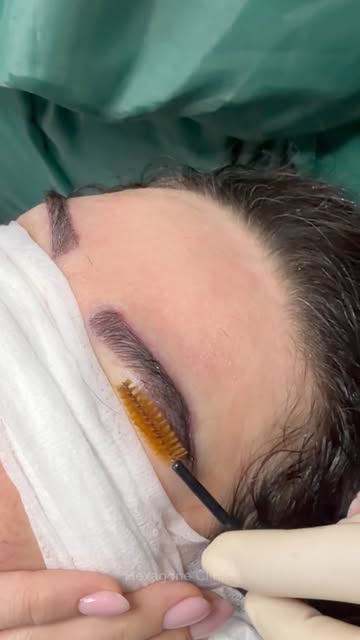 Des sourcils redessinés, sans rasage. 

Grâce à l’implantation de poils longs, le résultat est visib