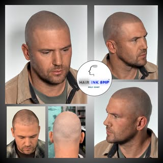 ✨ NOT EVERY HAIR TRANSPLANT ENDS WITH THE RESULT YOU EXPECT… ✨

This client underwent an FUE hair tr