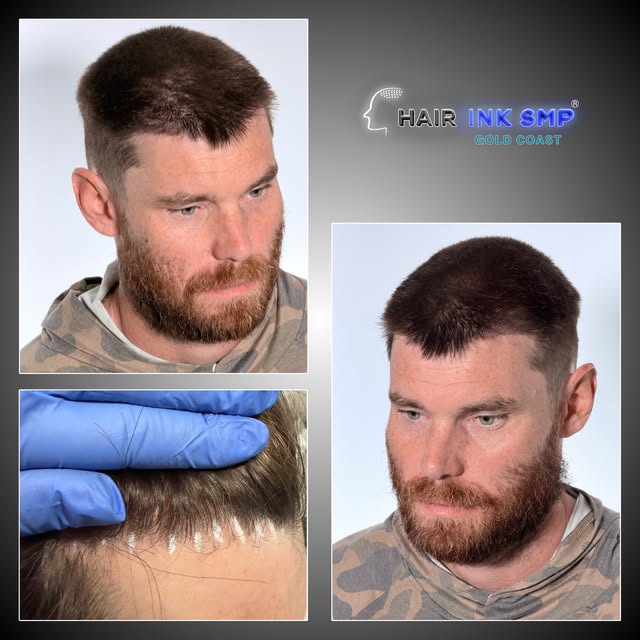 THE FINISHING TOUCH AFTER A HAIR TRANSPLANT 👌

This client previously had a hair transplant, but wa
