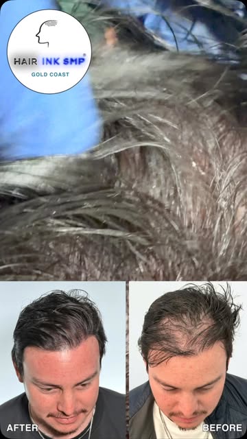 🔥 THINNING HAIR? SMP CAN MAKE A HUGE DIFFERENCE. 🔥

This client was experiencing noticeable thinni