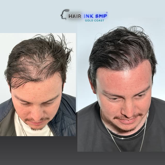 🔥 THINNING HAIR? NOW FULLER WITH SMP. 🔥

This client was experiencing noticeable thinning through 