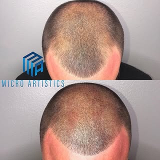 Before and after 2nd session 🔵MICRO ARTISTICS🔵
SCALP MICRO PIGMENTATION 
Work done by @cutz310 
#s