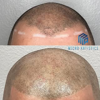 SCALP MICRO PIGMENTATION is the best solution to hair loss with guaranteed natural results‼️ No more
