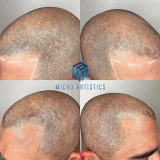 Scalp Micro Pigmentation 
NO more hats 🧢 
NO more fibers
NO more sprays
Being bald is a choice now 