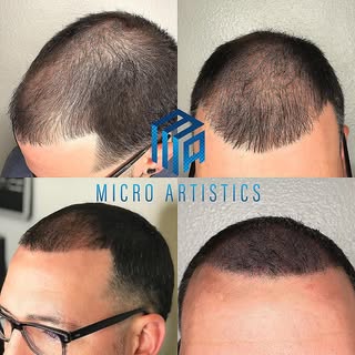 Scalp Micro Pigmentation 
NO more hats 🧢 
NO more fibers
NO more sprays
Being bald is a choice now 