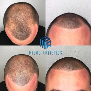 Scalp Micro Pigmentation 
NO more hats 🧢 
NO more fibers
NO more sprays
Being bald is a choice now 