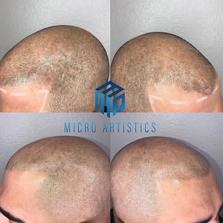 Scalp Micro Pigmentation 
NO more hats 🧢 
NO more fibers
NO more sprays
Being bald is a choice now 