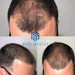 Nice results for a 2nd session💉🔥
Scalp Micro Pigmentation (SMP) is one of the best solutions to ha