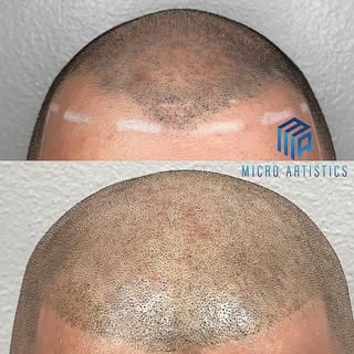 Bring your hairline back for the summer 20%off your procedure through the rest of July so book your 