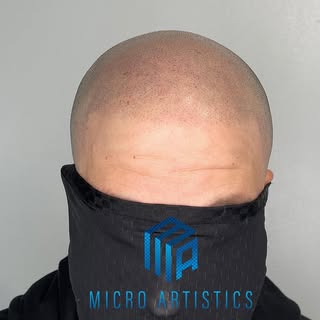 Been gone a while but plenty more New Procedures coming! #smp #scalpmicropigmentation #scalp #hairlo