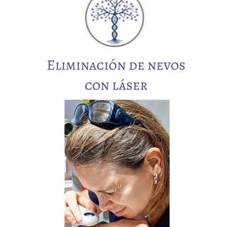 La eliminación de nevos (lunares) con láser CO₂ es un procedimiento preciso que permite tratar lesio