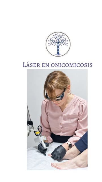 La onicomicosis no siempre requiere un único tratamiento. 🦶✨ En uñas muy engrosadas, con hiperquera