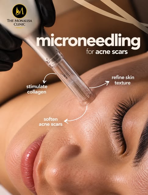 Acne is gone, but the scars stayed? 👀

Microneedling works with your skin’s natural repair process 