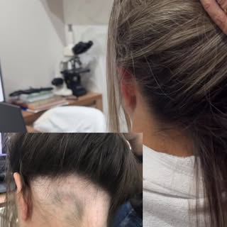 A alopecia areata é uma condição multifatorial.
Não acontece do nada.
Ela conversa com o emocional, 