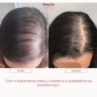 Alopecia androgenética feminina 

Crônica, progressiva e influenciada por genética e ação hormonal.
