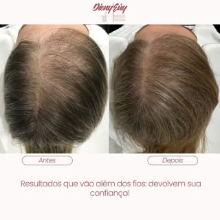 A alopecia androgenética feminina causa aquela transparência indesejada no couro cabeludo, mas você 
