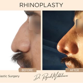 I study the Anthropometry of the face to find that perfect angle, shape and proportion to the transf