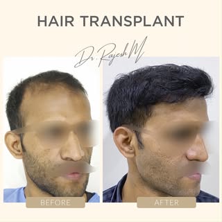 5 Months post Hair Transplant.
By the way, I do Moustaches and Beards too... 😉

#hair #hairloss #ha