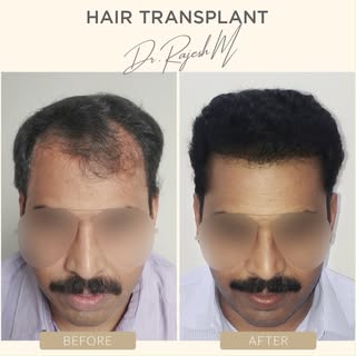 Committed to the RESULTS!

#hair #hairloss #hairlosssolution #hairlosstreatment #hairtransplant #fue