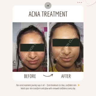 Don’t let acne dull your shine — we’ve got your glow covered!
Heal, renew, and reveal your best skin
