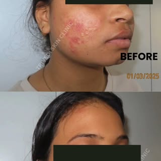 From battling acne to glowing confidence 
Listen to our happy client share her journey of clear skin