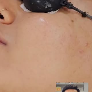TCA CROSS Treatment for Acne Scars – Dr. Sunil Trivedi, Trivedi Skin Clinic (Surat)
If you’re consid