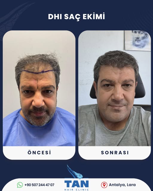 DHI saç ekiminde başarılı bir planlama; saç çizgisi, yoğunluk, yön ve mevcut saç yapısının birlikte 