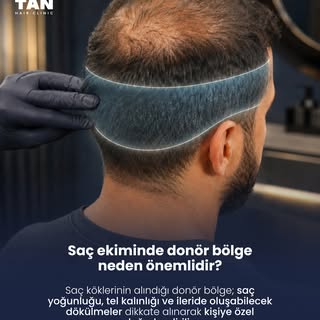 Saç ekiminde yalnızca ekim yapılacak alan değil, saç köklerinin alınacağı donör bölge de sürecin en 