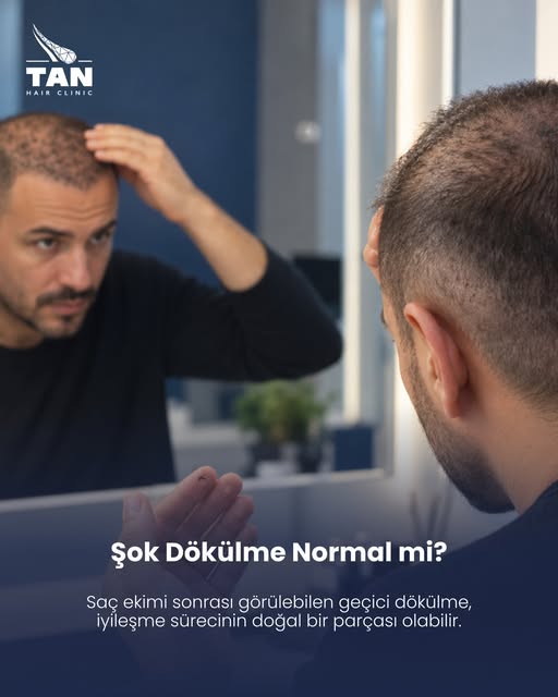 Saç ekimi sonrası ekilen saçların bir bölümünün dökülmesi, birçok kişiyi endişelendiren ancak çoğu z