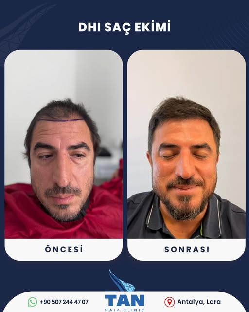 Saç ekiminde değişimi en net gösteren şey, yalnızca ön saç çizgisi değil; üst bölgedeki genel dolulu