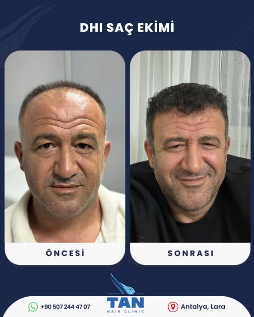DHI saç ekiminde planlama, yalnızca açıklığı kapatmaya değil; saç çizgisini, yoğunluğu ve genel görü