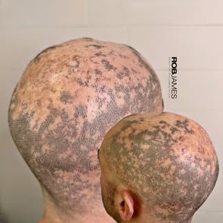 Severe scarring alopecia — and years of frustration, stress, and self-consciousness.
This client had