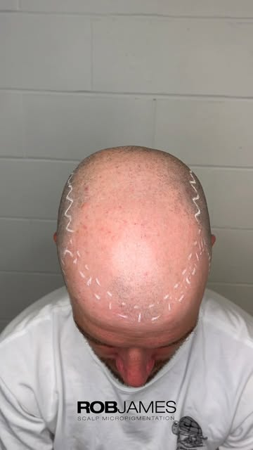 NATURAL SMP 🍃 — NOT ALL RESULTS ARE CREATED EQUAL.

Great Scalp Micropigmentation shouldn’t scream 