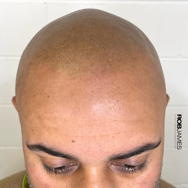 LIGHTWEIGHT SMP. SUBTLE. NATURAL. REALISTIC.

Scalp Micropigmentation doesn’t need to be dark or hea