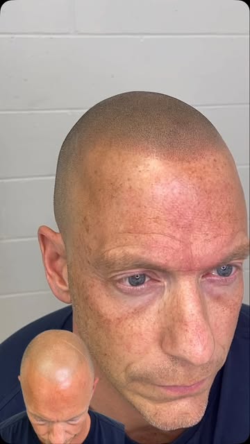 Your SMP can look perfect… until the light hits it. 💡

Scalp shine can make even natural SMP more n