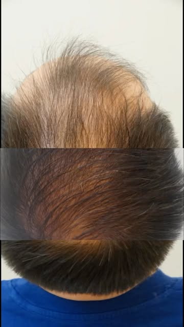 Um antes e depois que representa cuidado, constância e evolução. ✨

Cada tratamento é planejado de f